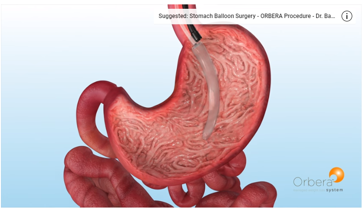 Stomach Balloon Surgery ORBERA Animation Dr. Bagshahi